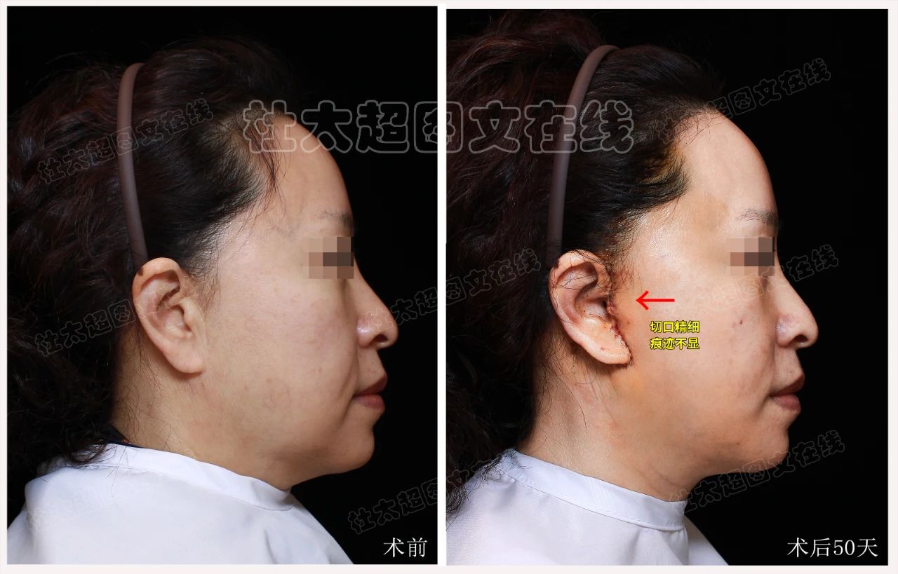 拉皮手术效果怎么样？这不是不要脸，是我追求美的权利！55岁又怎样？