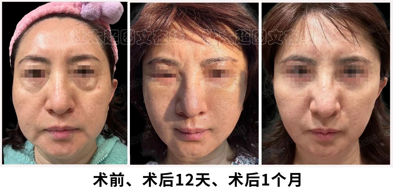 一个成功的拉皮手术应该具备哪些特点和优势呢? 一个成功的拉皮手术应该具备哪些特点和优势呢?