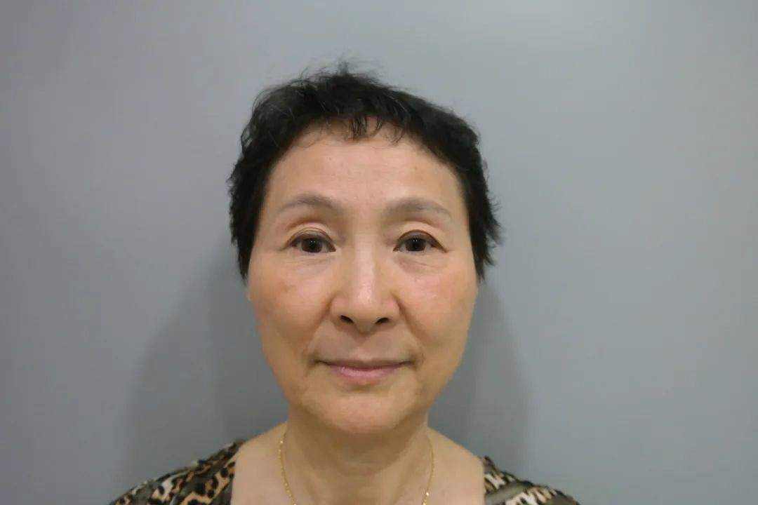 这样的拉皮手术太震惊了！68岁还能青春逆袭？这个世界怎么了？