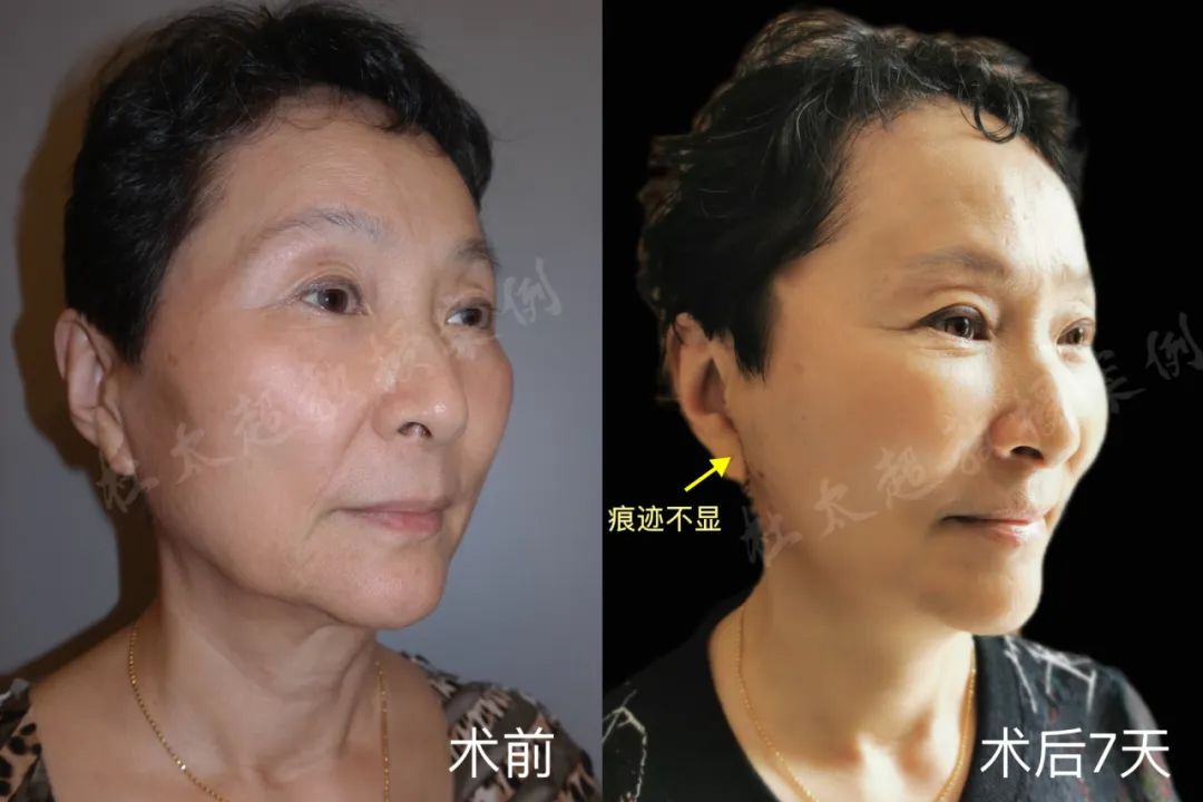 这样的拉皮手术太震惊了！68岁还能青春逆袭？这个世界怎么了？