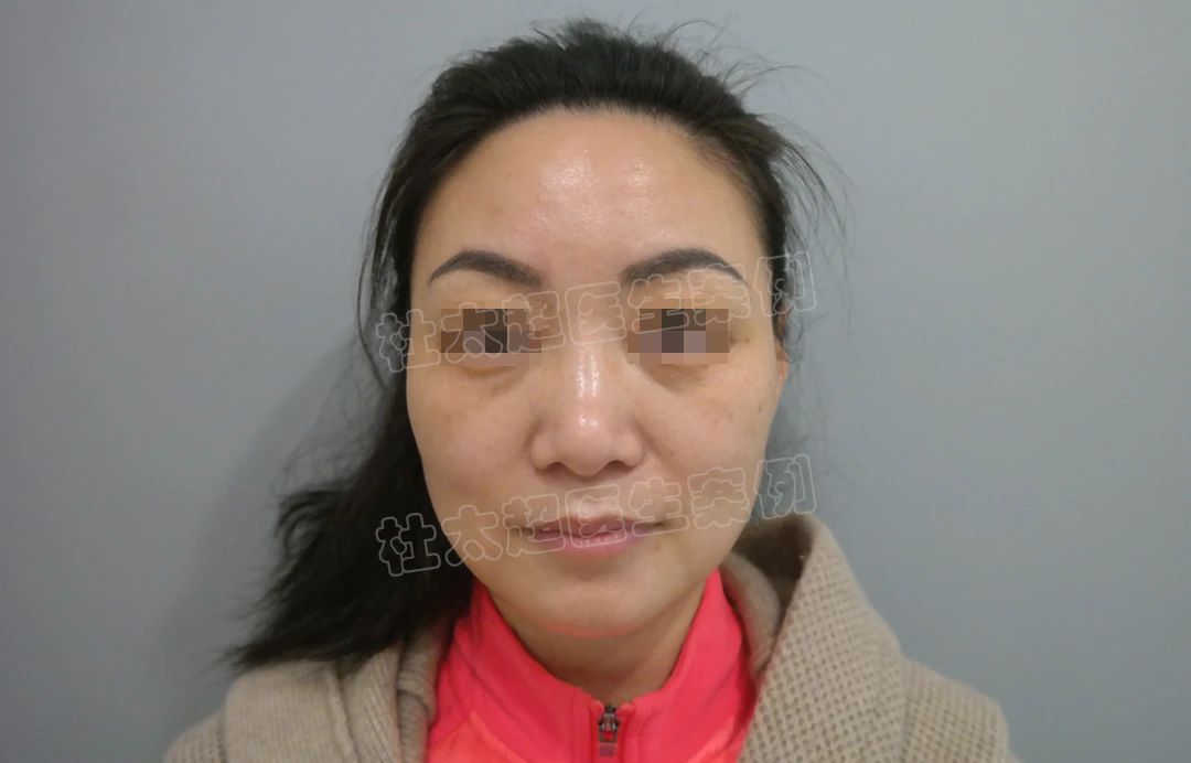 拉皮手术效果怎么样？49岁求美者拉皮手术术后案例深度分析