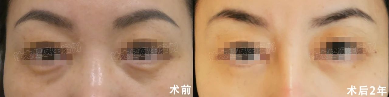 拉皮手术效果怎么样？49岁求美者拉皮手术术后案例深度分析