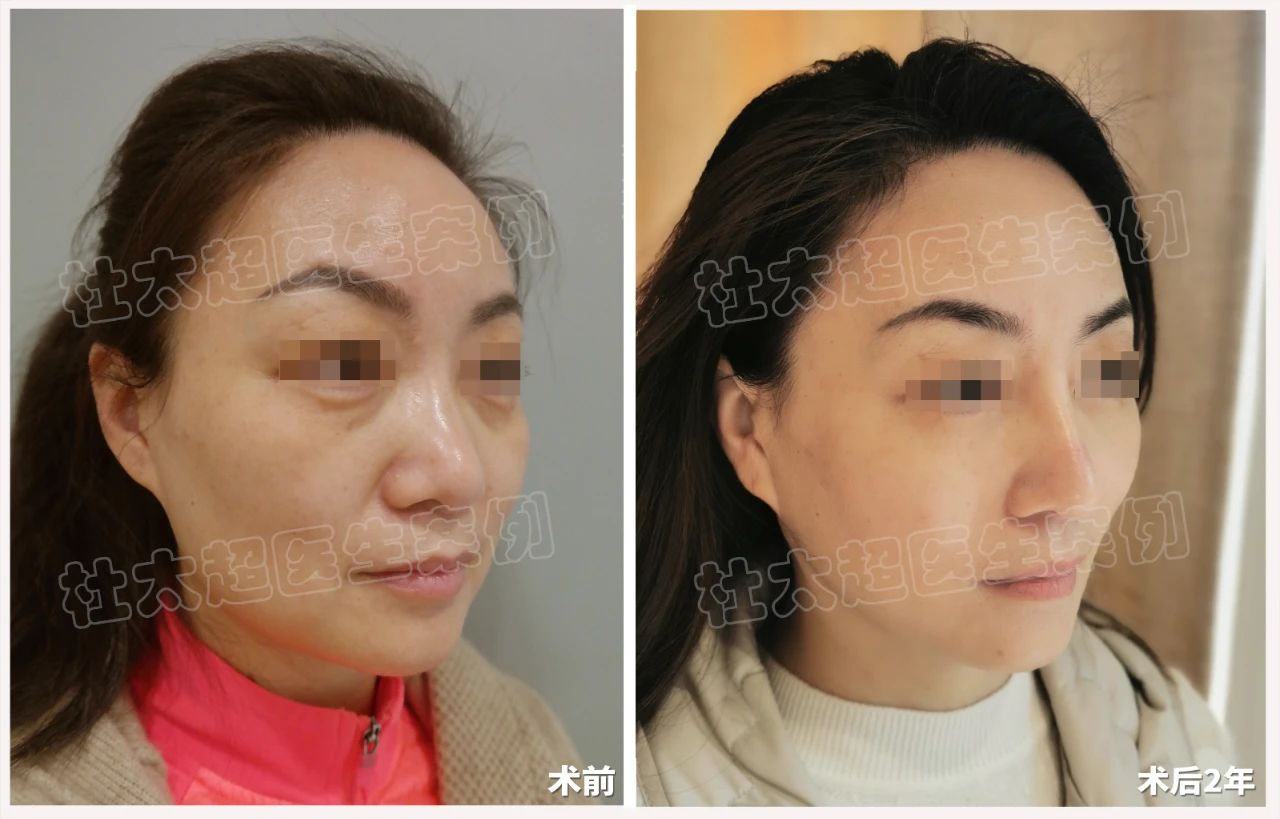 拉皮手术效果怎么样？49岁求美者拉皮手术术后案例深度分析