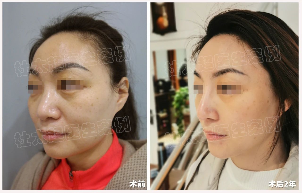 拉皮手术效果怎么样？49岁求美者拉皮手术术后案例深度分析