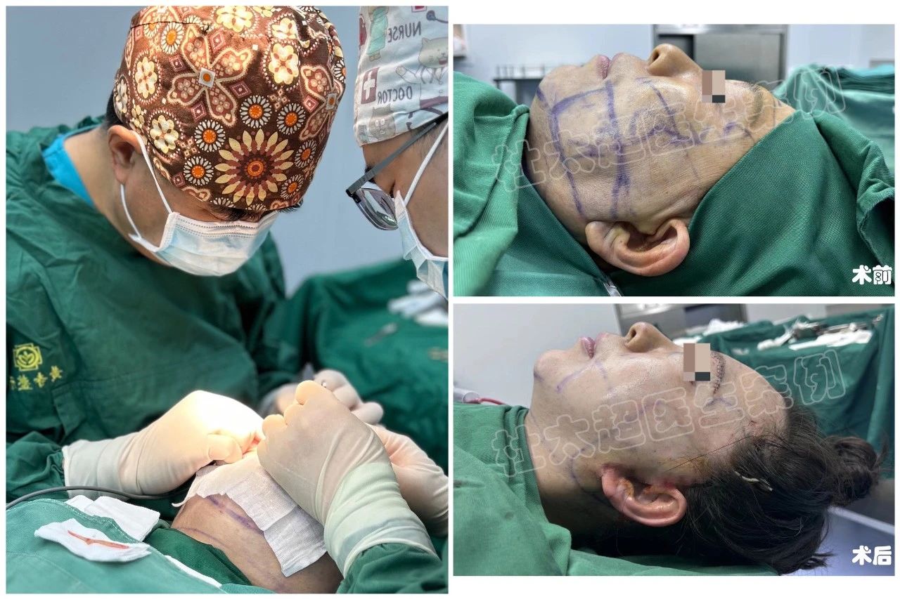 拉皮手术怎么样？70岁老妈神操作！力挺50岁女儿，拉皮手术大变样！