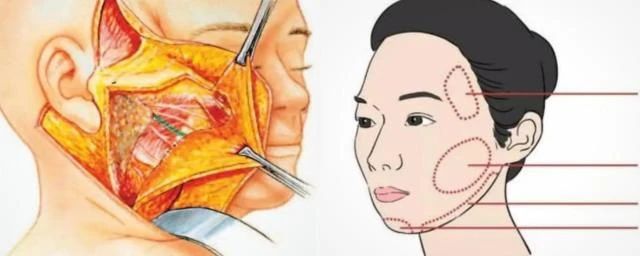 关于拉皮手术多少钱？1分钟讲清你最关心的这些事！