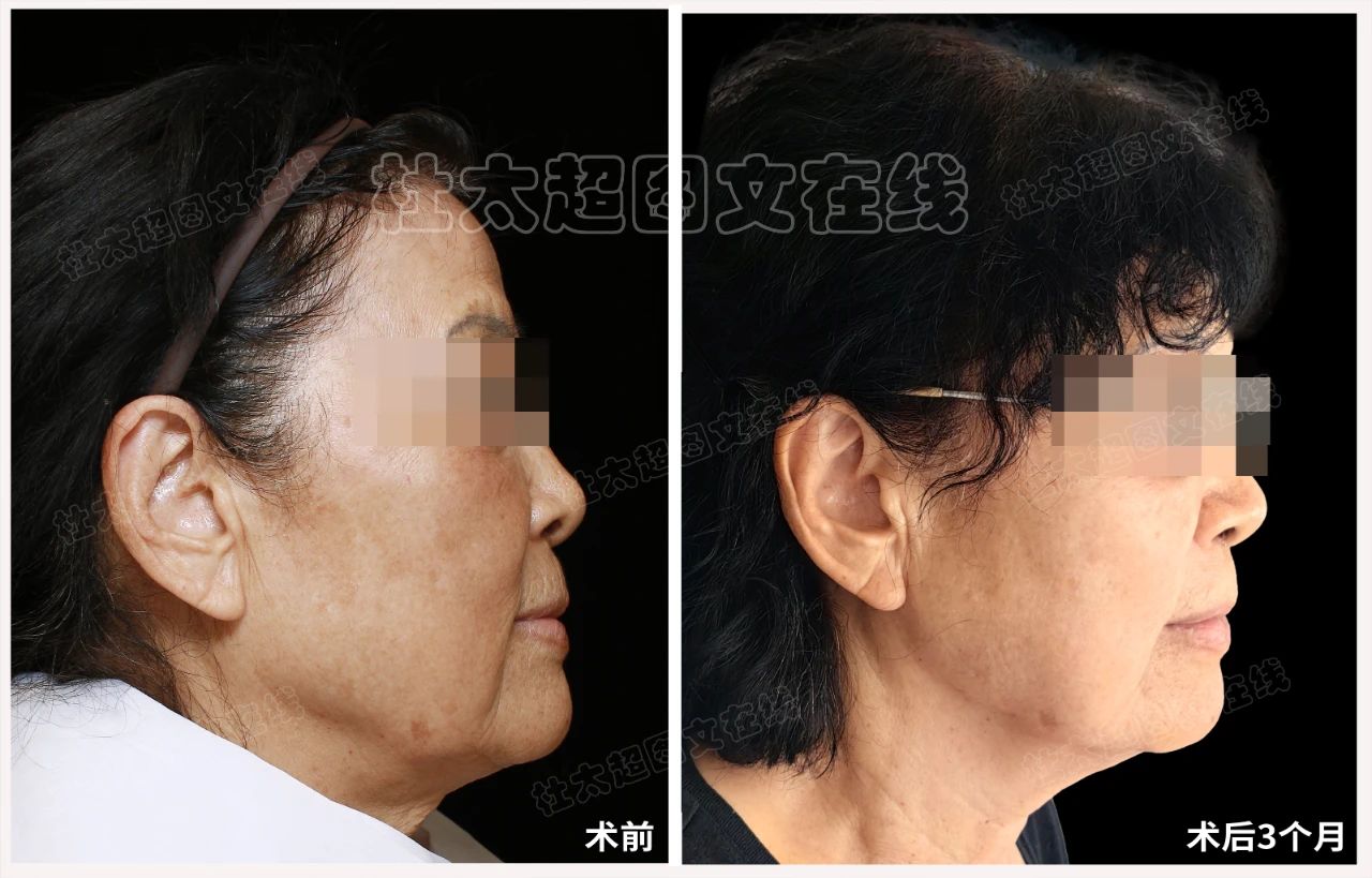 71岁如何通过caw小切口面部提升缩紧术改善面部老化！全过程深度刨析！