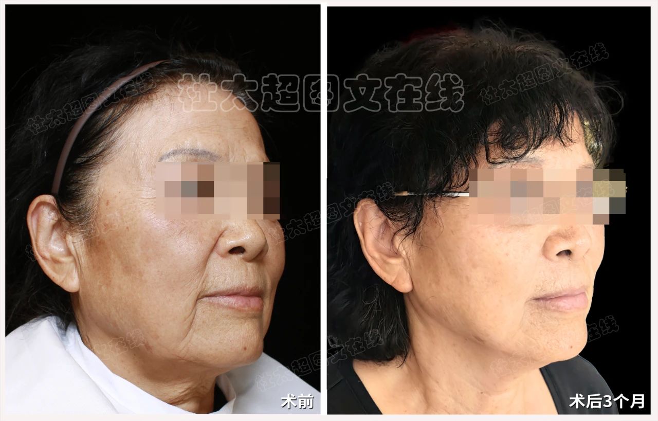 71岁如何通过caw小切口面部提升缩紧术改善面部老化！全过程深度刨析！
