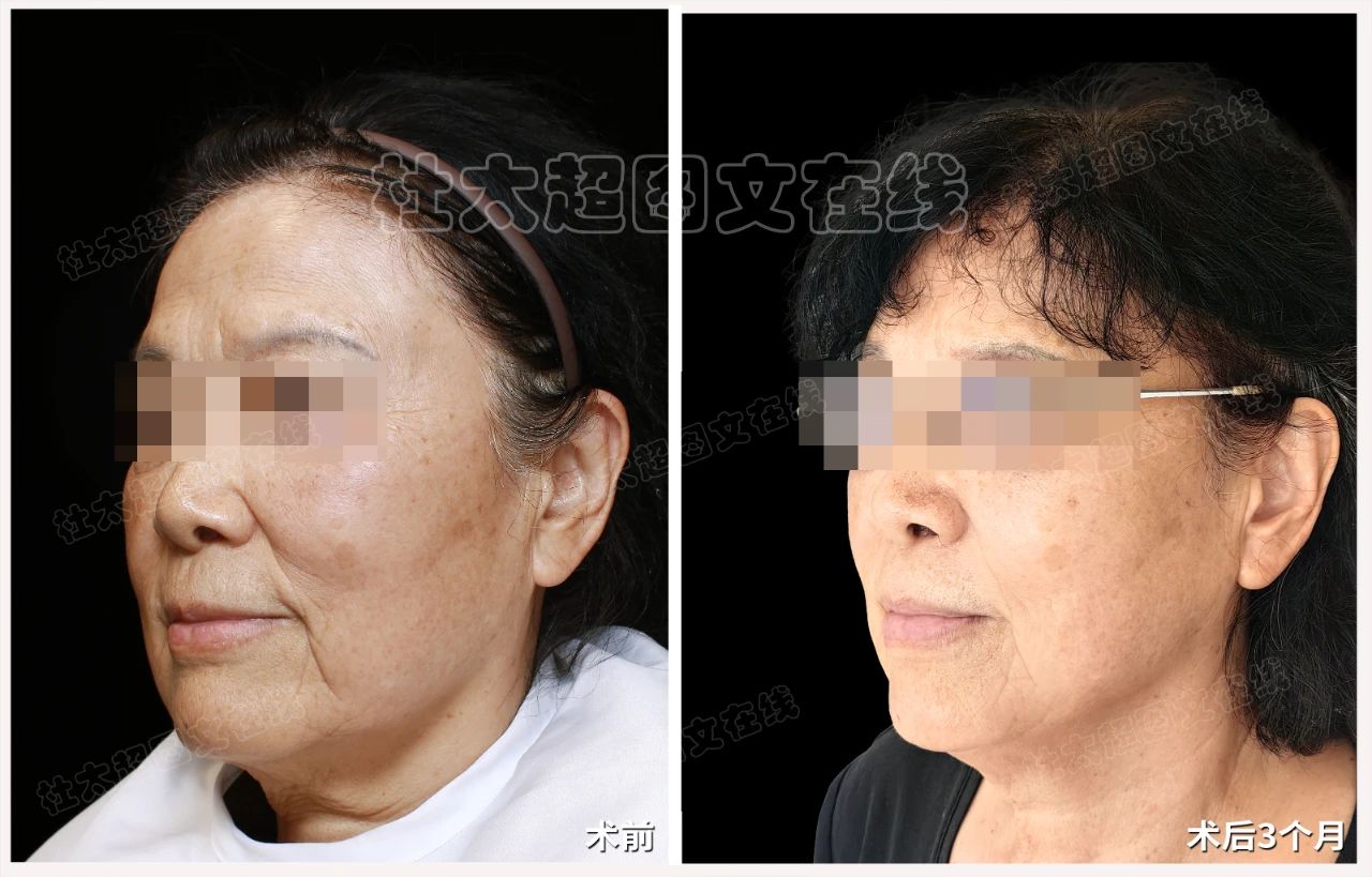 71岁如何通过caw小切口面部提升缩紧术改善面部老化！全过程深度刨析！