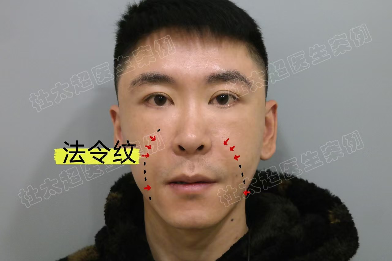 33岁男士做了拉皮手术，分享求美历程及效果