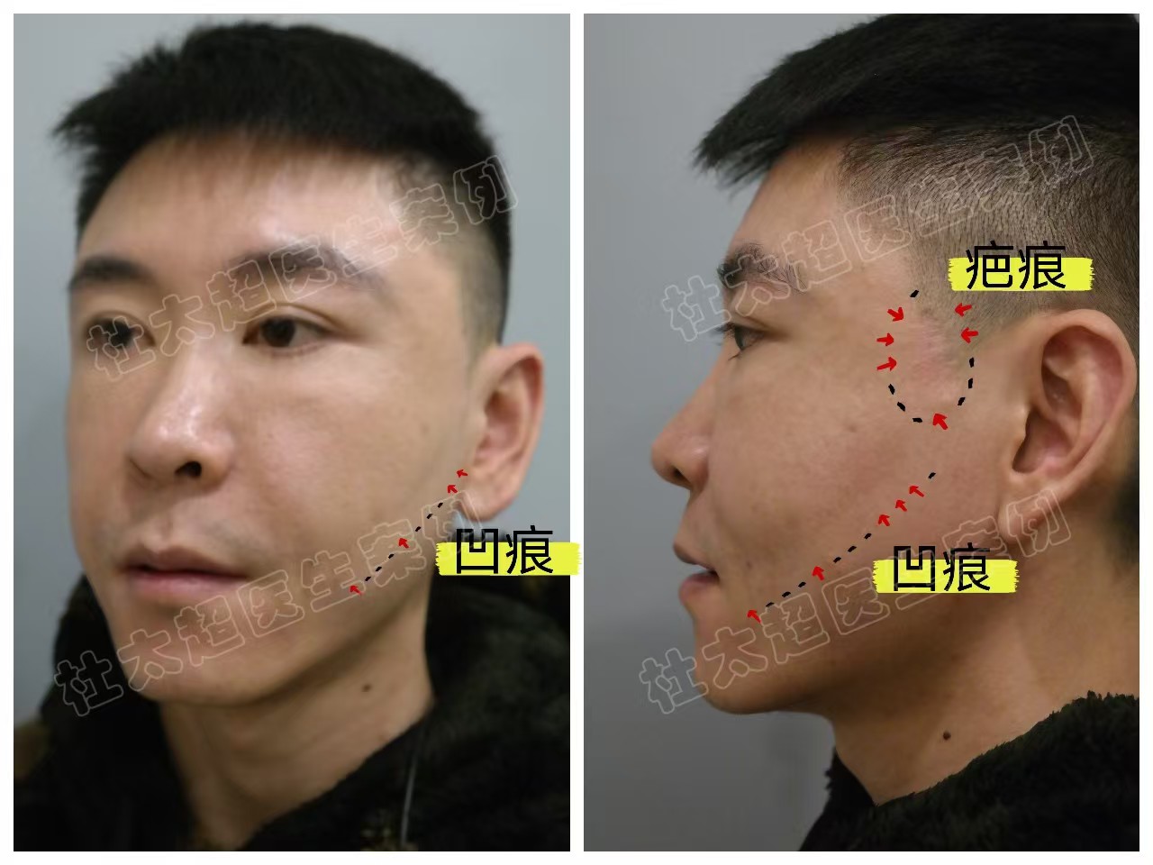 33岁男士做了拉皮手术，分享求美历程及效果