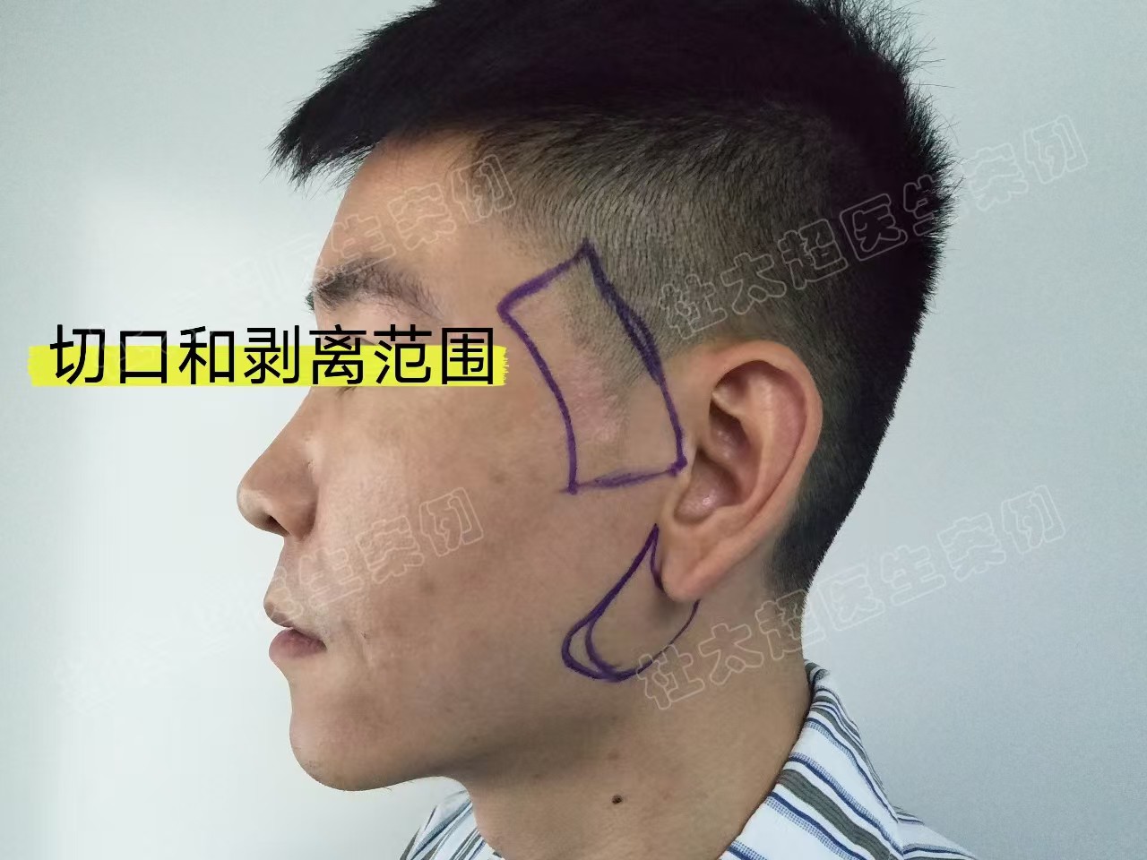 33岁男士做了拉皮手术，分享求美历程及效果