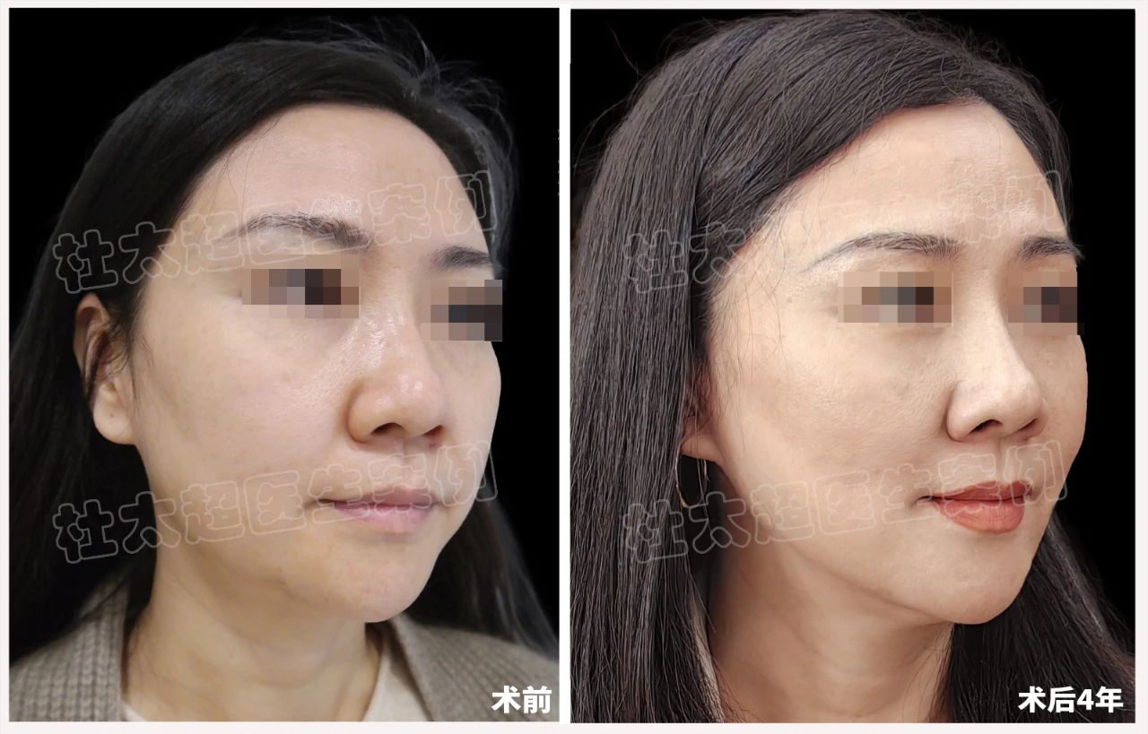 48岁女士拉皮手术后4年全过程深度分析！