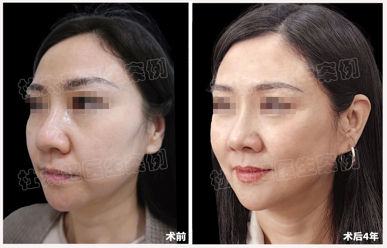 48岁女士拉皮手术后4年全过程深度分析！
