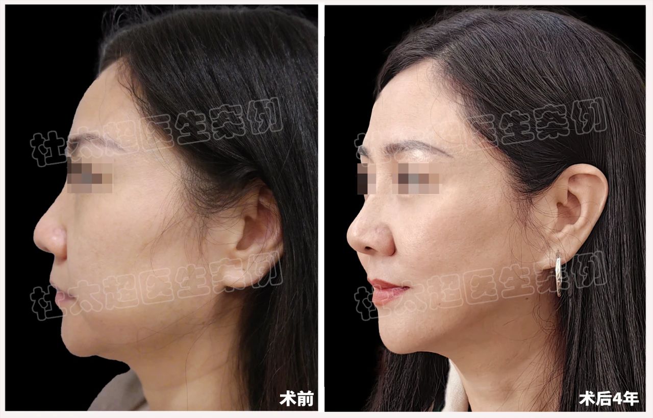 48岁女士拉皮手术后4年全过程深度分析！