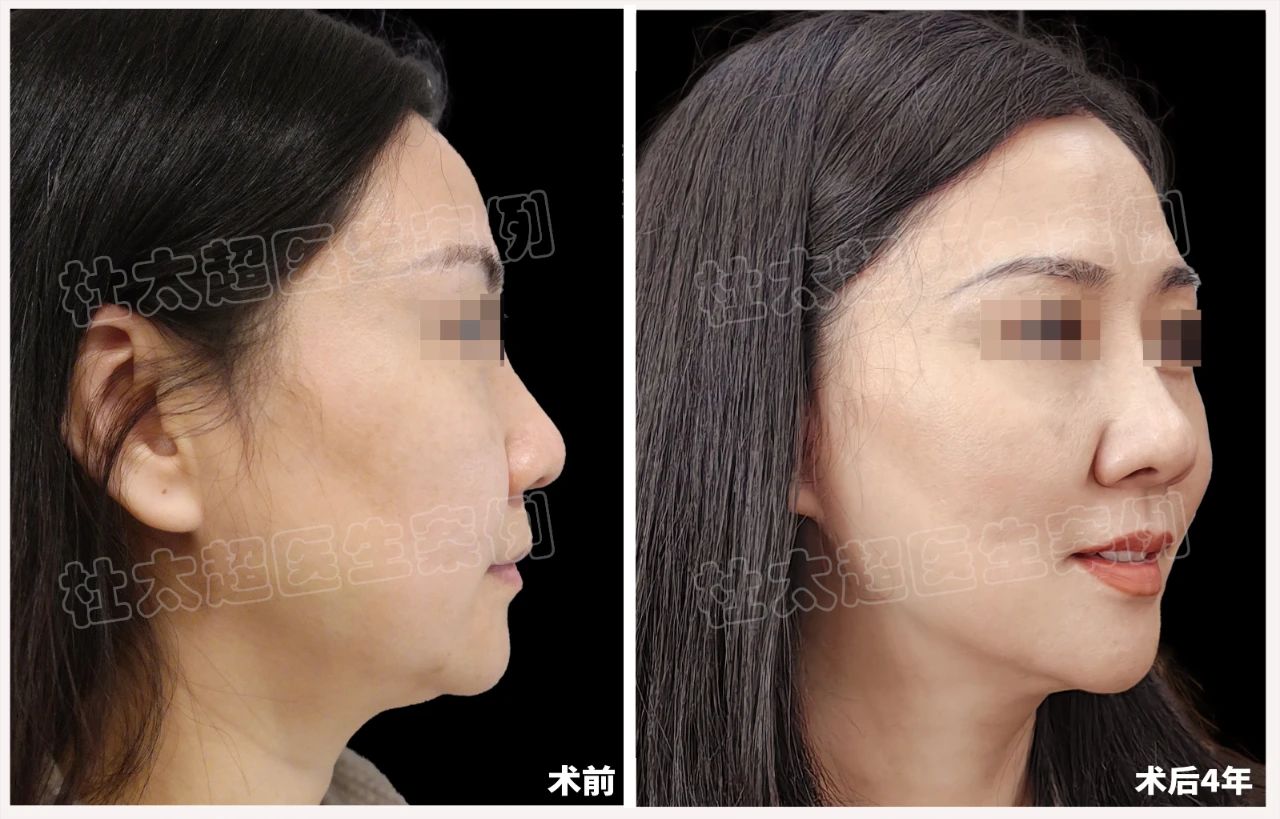 48岁女士拉皮手术后4年全过程深度分析！