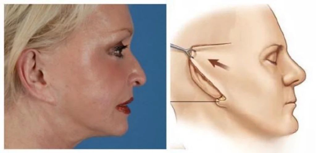 大拉皮手术为何易现“短命”与“假面感”,caw小切口面部缩紧术优势何在? 大拉皮手术为何易现“短命”与“假面感”,caw小切口面部缩紧术优势何在?