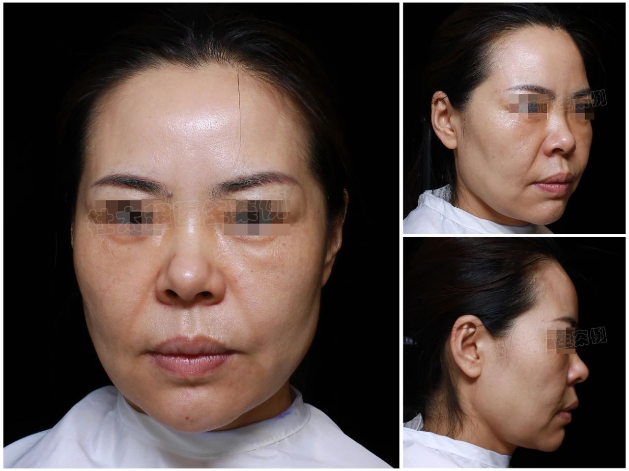 线雕差点毁了她？揭秘42岁为何两次尝试后她仍选择拉皮手术重生！