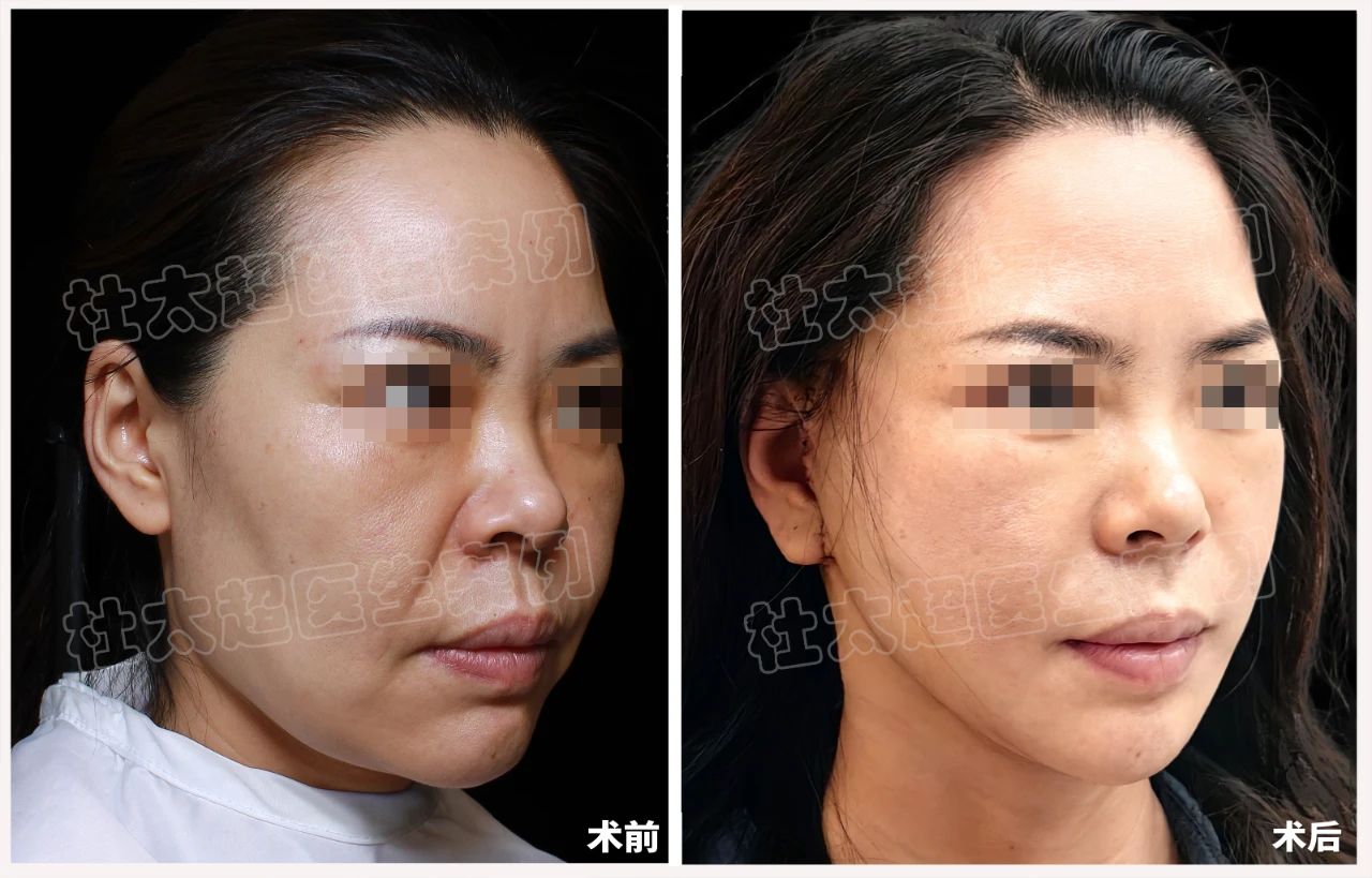 线雕差点毁了她？揭秘42岁为何两次尝试后她仍选择拉皮手术重生！