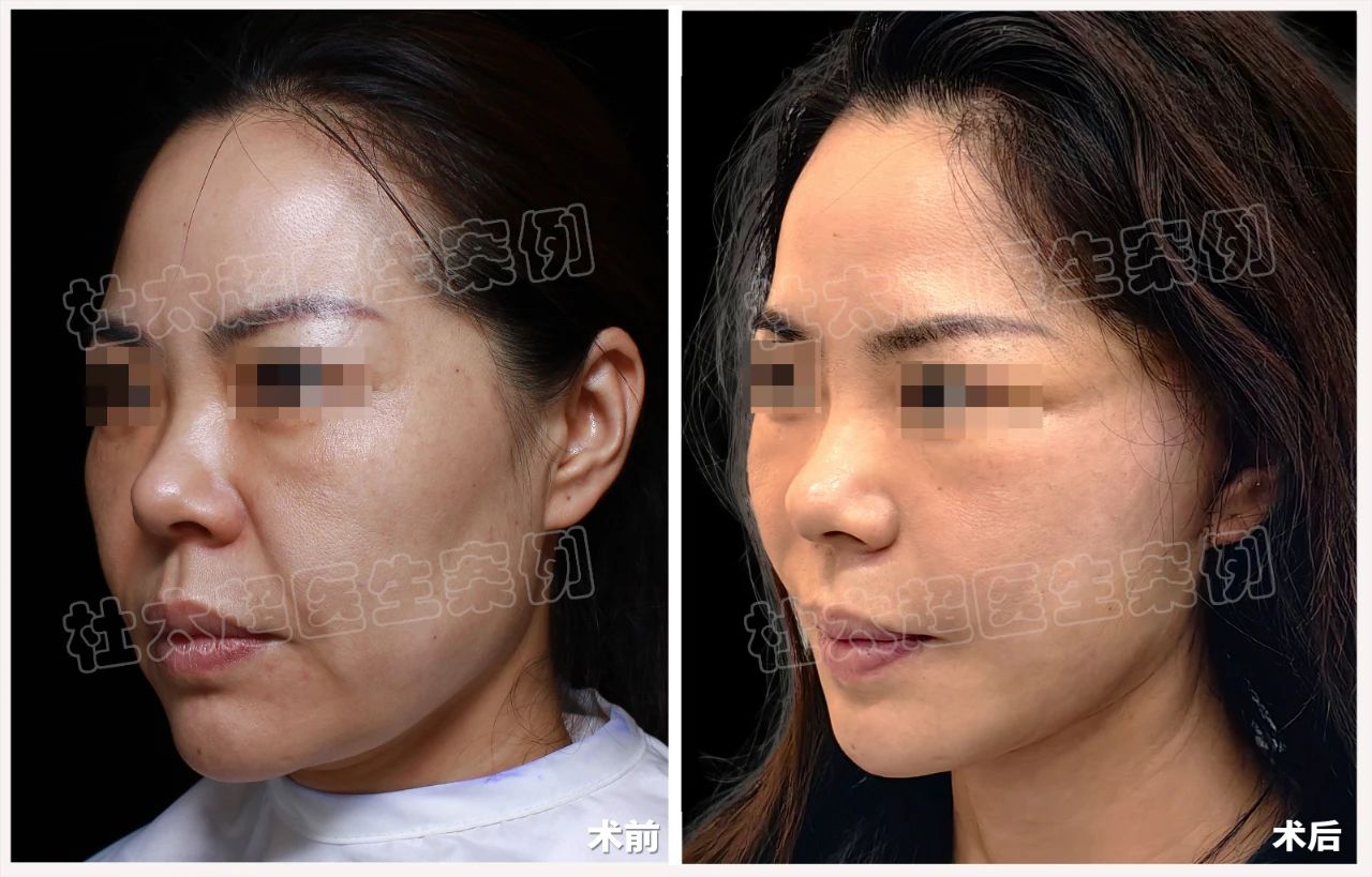 线雕差点毁了她？揭秘42岁为何两次尝试后她仍选择拉皮手术重生！