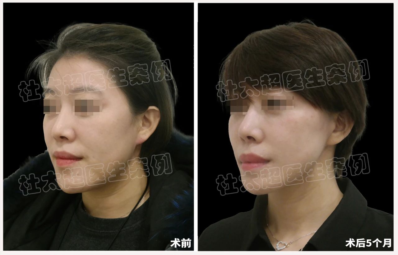 39岁女士caw小切口面部紧缩术术后5个月深度分析