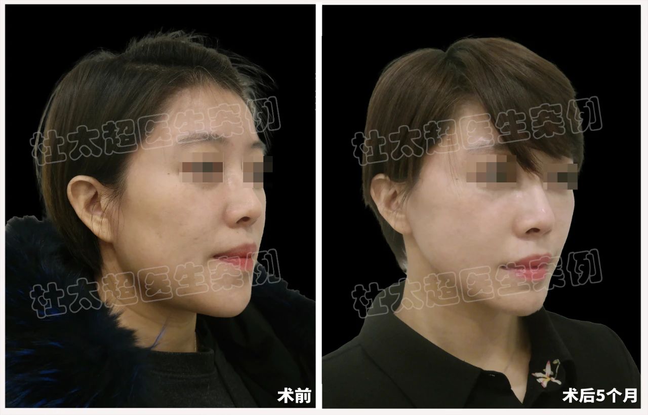 39岁女士caw小切口面部紧缩术术后5个月深度分析