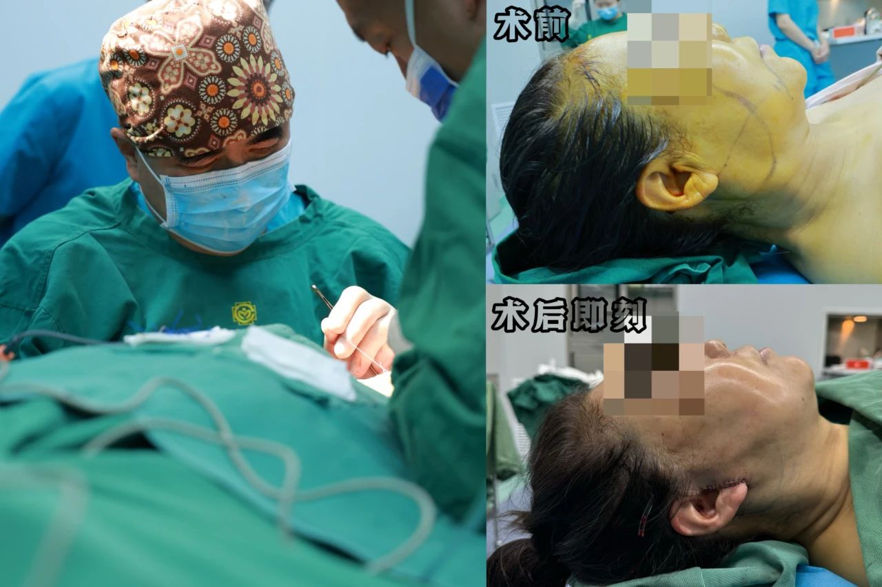 60岁整形成风？拉皮手术，是追求青春还是虚荣心作祟？