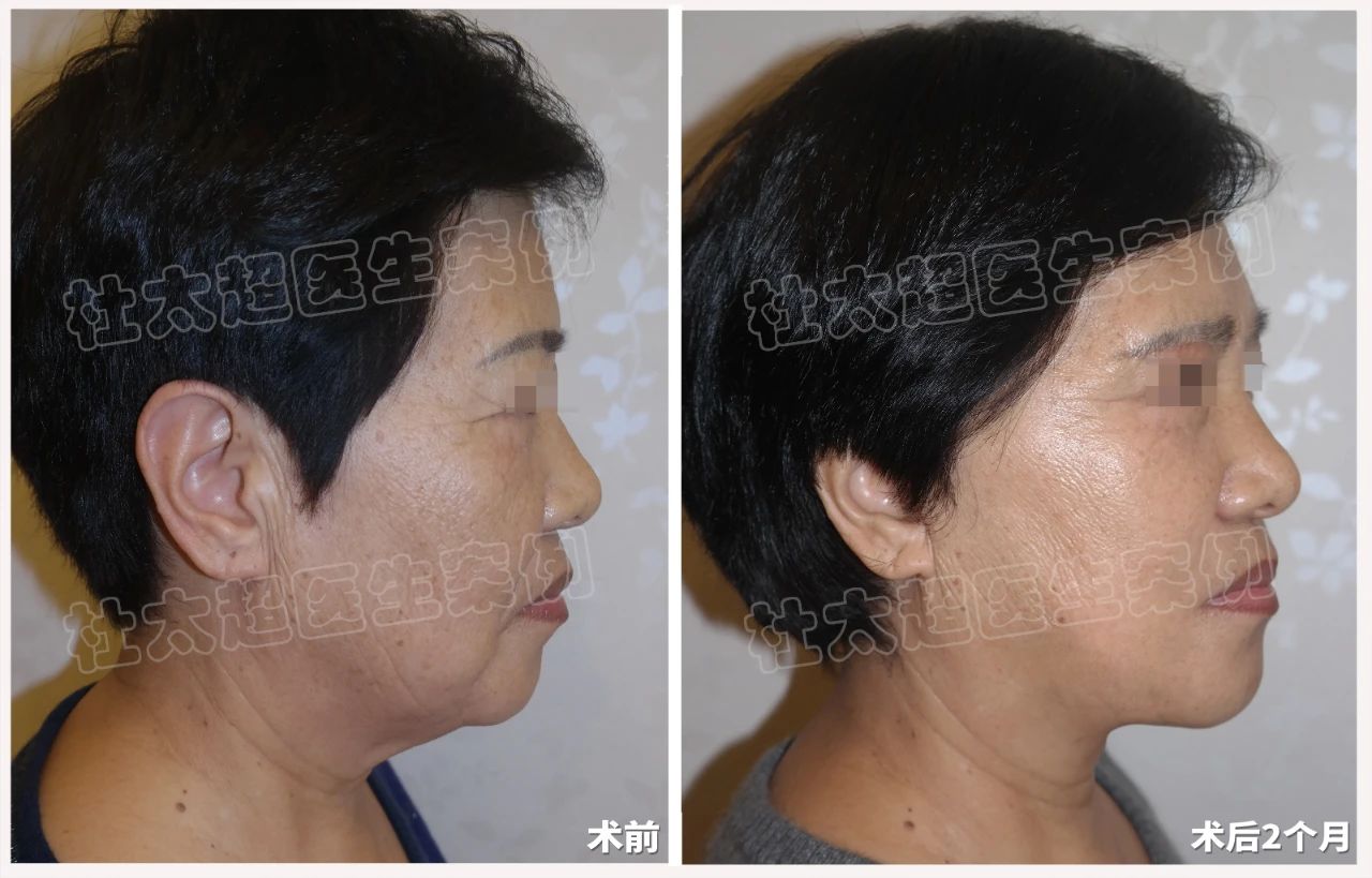 拉皮手术新趋势：64岁女士拉皮手术深度剖析