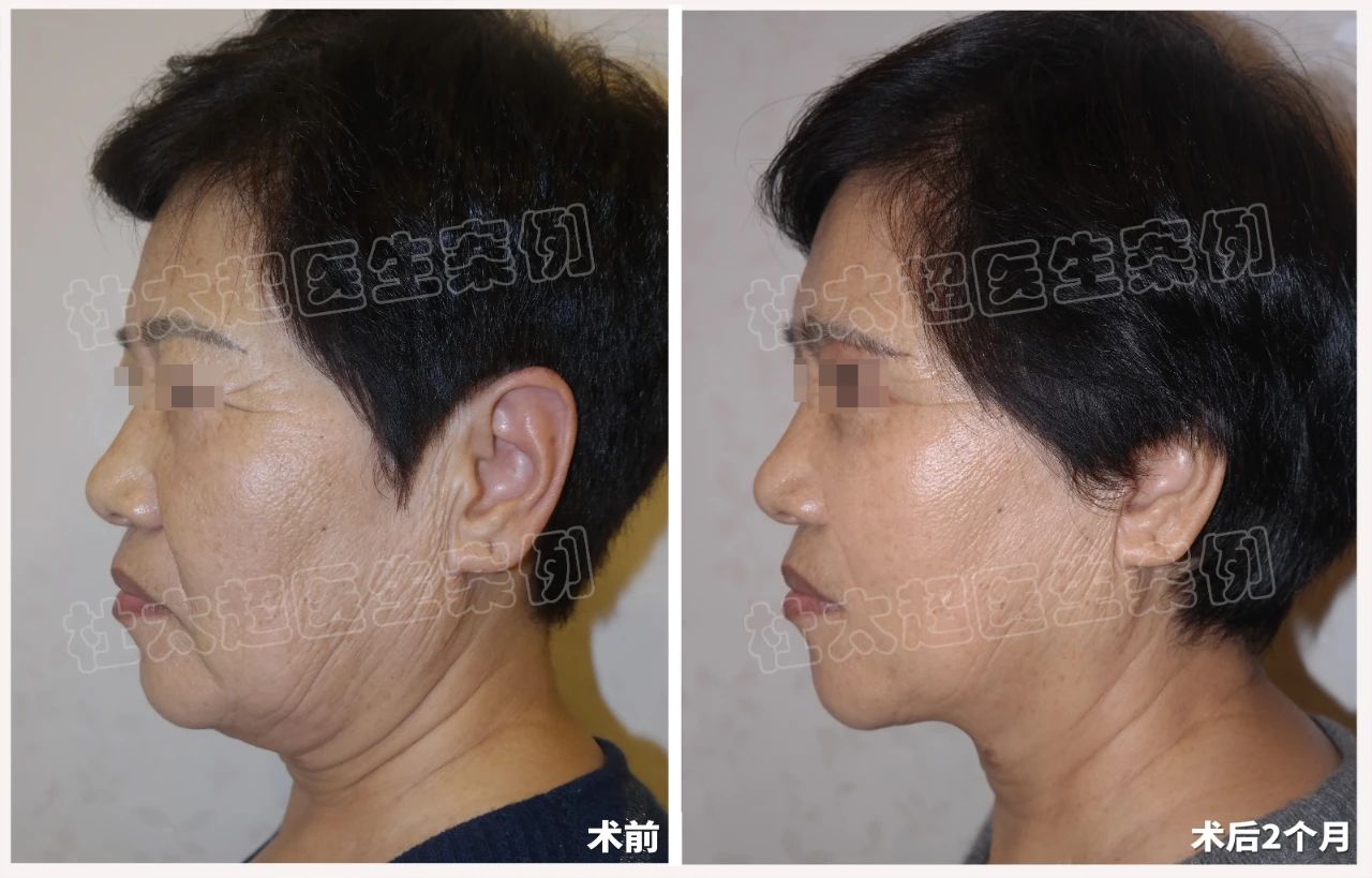 拉皮手术新趋势：64岁女士拉皮手术深度剖析