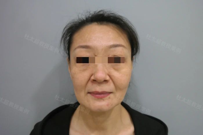 caw小切口面部紧缩术术后三个月、十个月深度分析：一位52岁女士的蜕变之旅