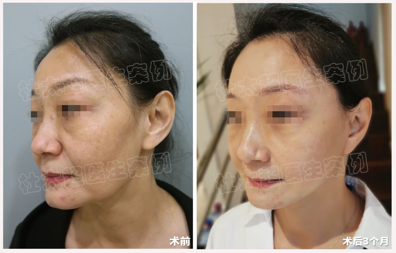 caw小切口面部紧缩术术后三个月、十个月深度分析：一位52岁女士的蜕变之旅
