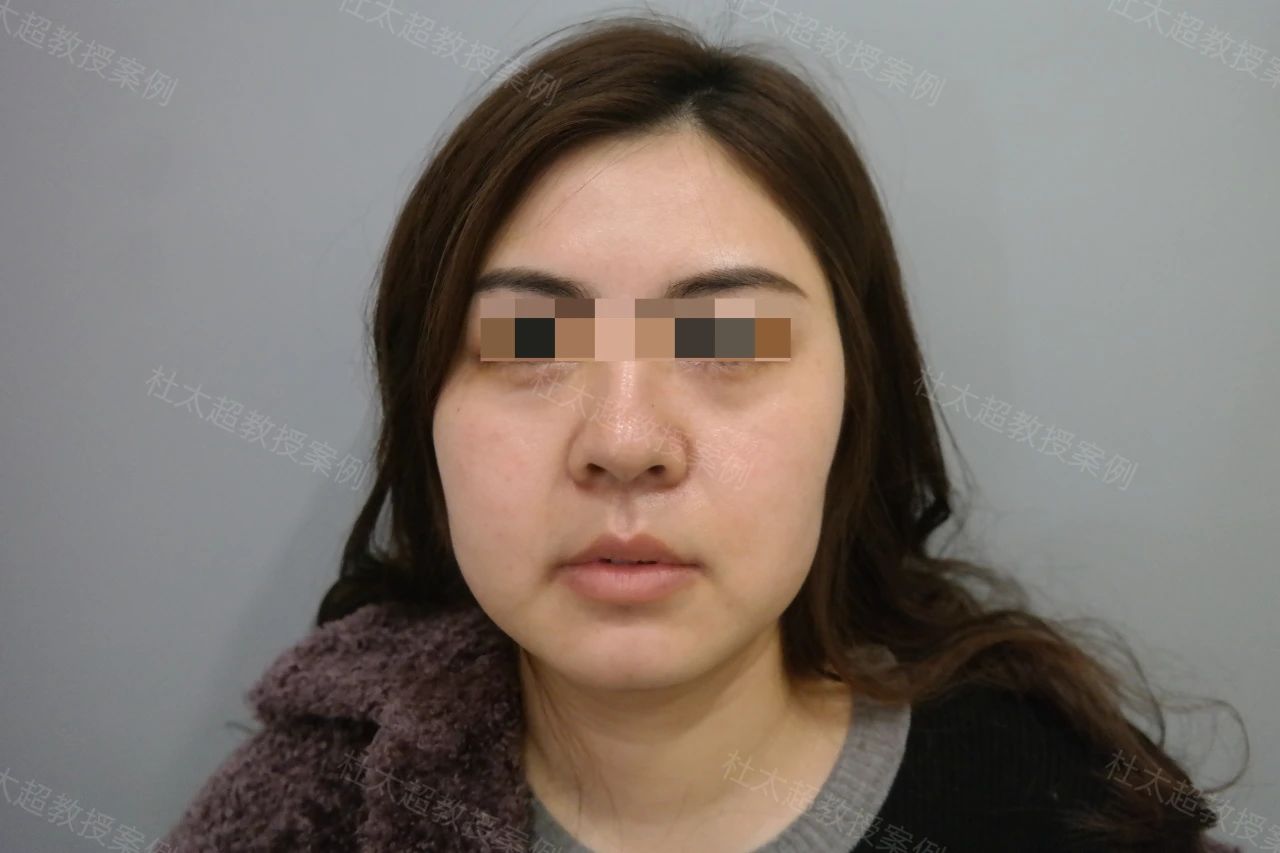 结果太震惊了！35岁就必须做拉皮手术？非手术方法真的无效吗？