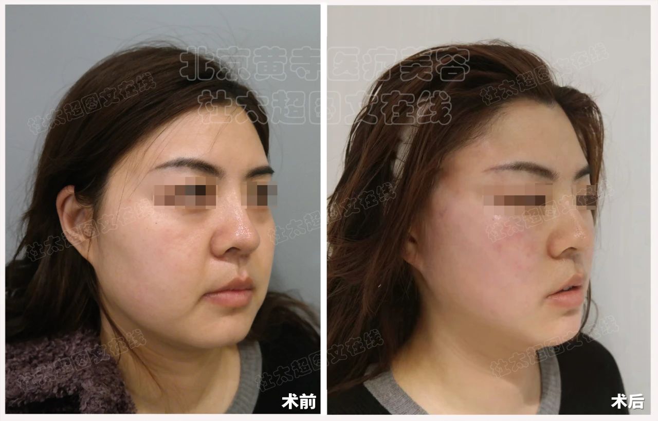 结果太震惊了！35岁就必须做拉皮手术？非手术方法真的无效吗？