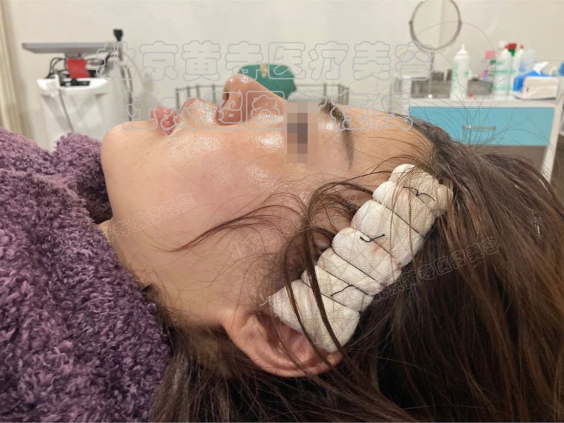 结果太震惊了！35岁就必须做拉皮手术？非手术方法真的无效吗？