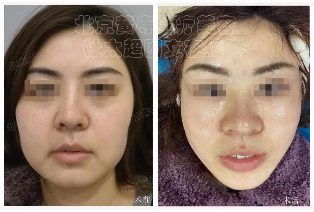 结果太震惊了！35岁就必须做拉皮手术？非手术方法真的无效吗？