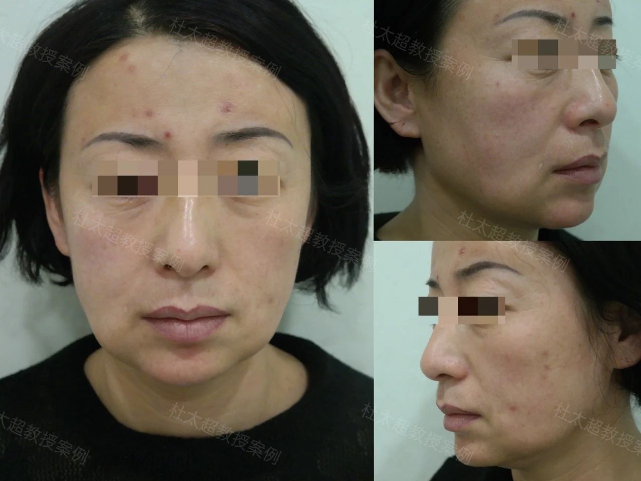 45岁求美者，拉皮手术后四个月深度分析改变全过程！