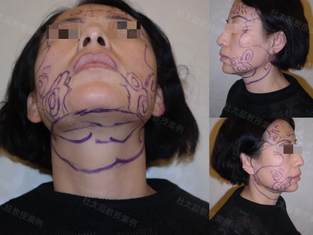 45岁求美者，拉皮手术后四个月深度分析改变全过程！