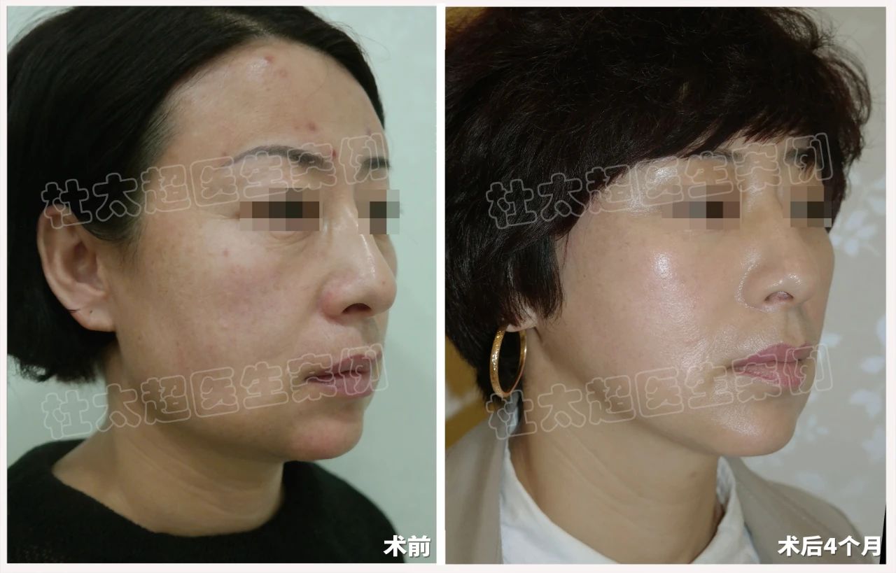 45岁求美者，拉皮手术后四个月深度分析改变全过程！