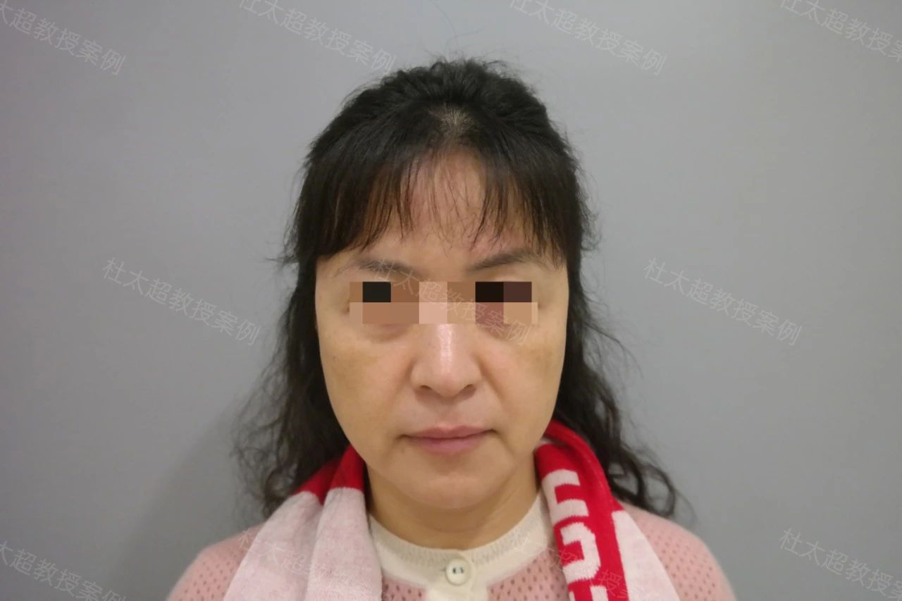 54岁拉皮手术后第四年，这样的效果值吗？真实反馈大曝光......