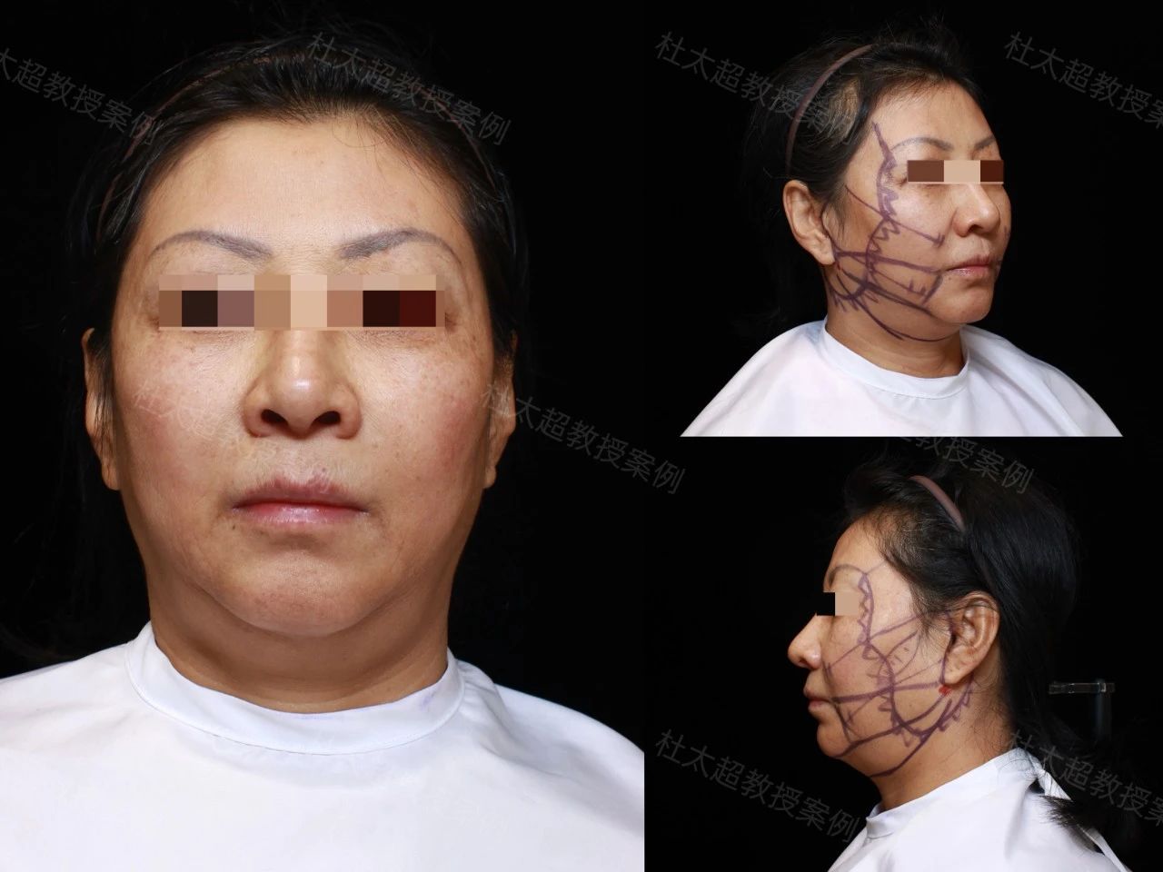 这个拉皮手术非做不可？57岁不顾劝阻引家庭纷争，术后一个月、三个月惊呼‘打脸’式转变！