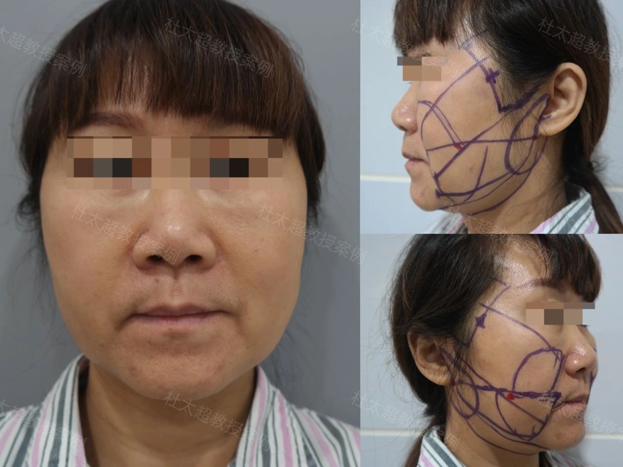54岁通过拉皮手术重拾青春，术后3个月深度解析