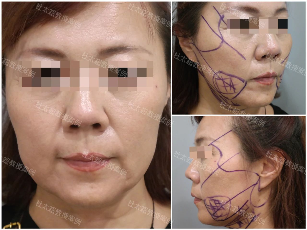 孤注一掷？56岁来做拉皮手术，是她最后的赌注还是自我救赎？