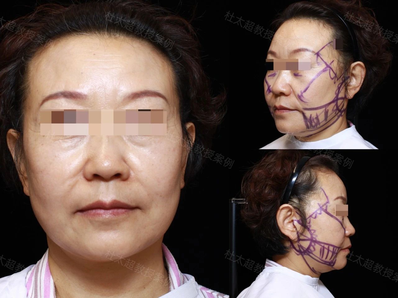 56岁求美者caw小切口面部提升缩紧术后一年深度分析