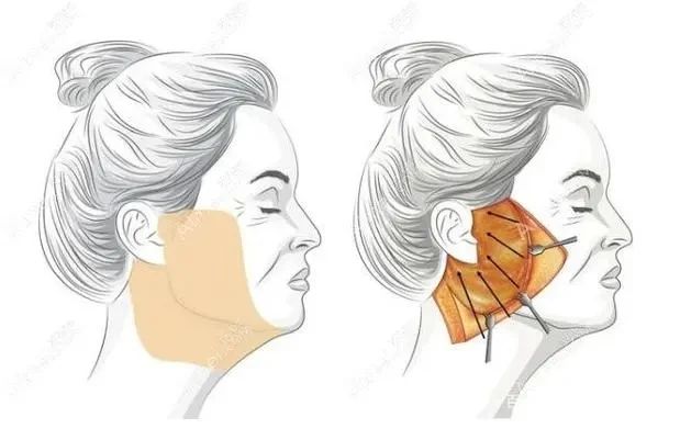 拉皮手术内幕：为何有人效果惊艳，有人却惨遭失败？