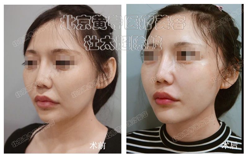 27岁女士caw小切口面部提升缩紧术后7天深度分析