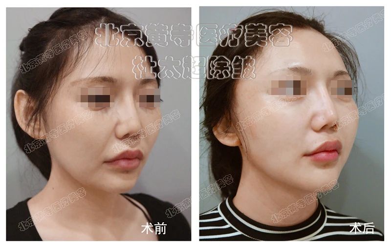 27岁女士caw小切口面部提升缩紧术后7天深度分析