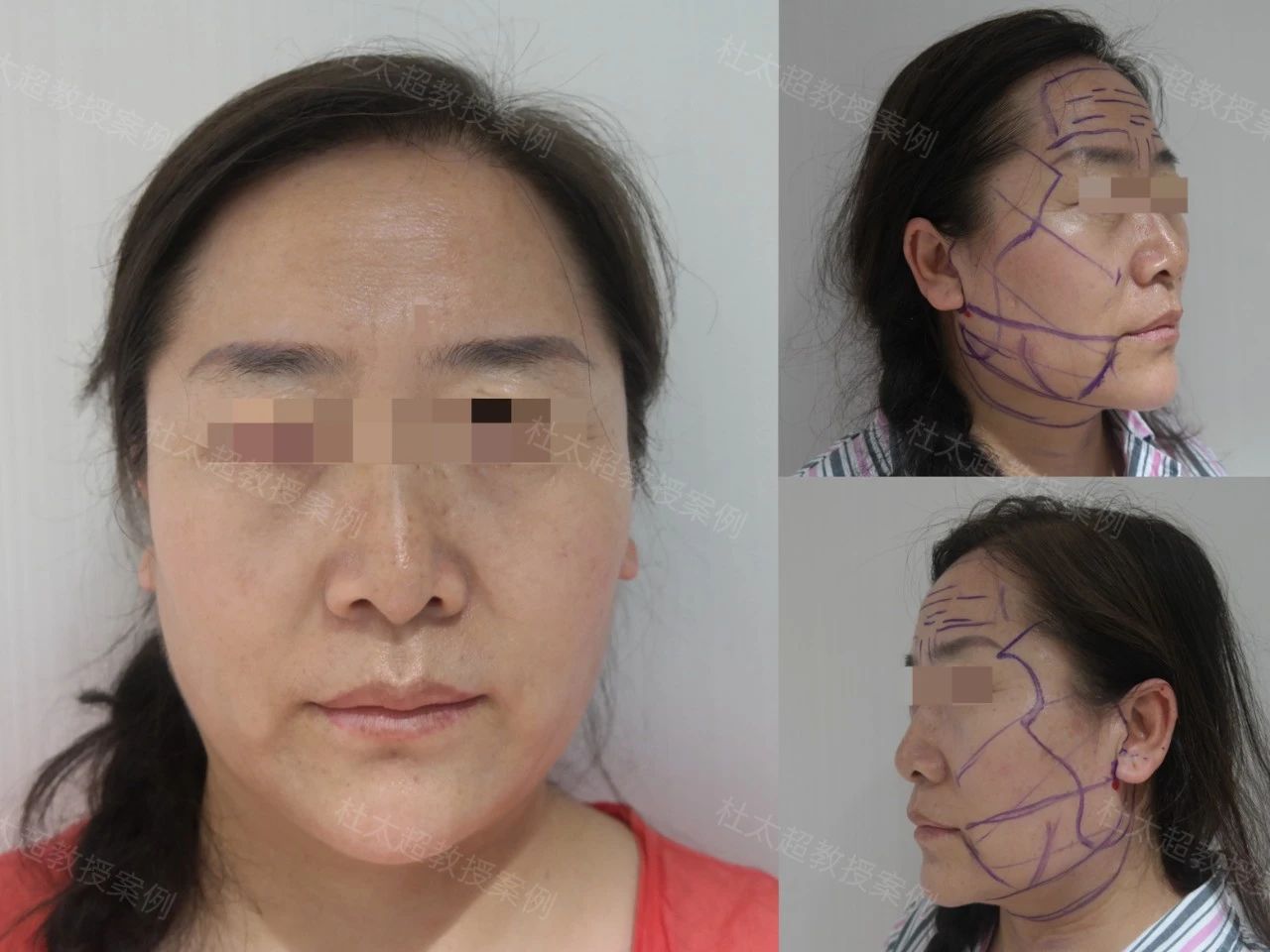 教师来做拉皮手术引热议，是对学生不负责吗？您怎么看？