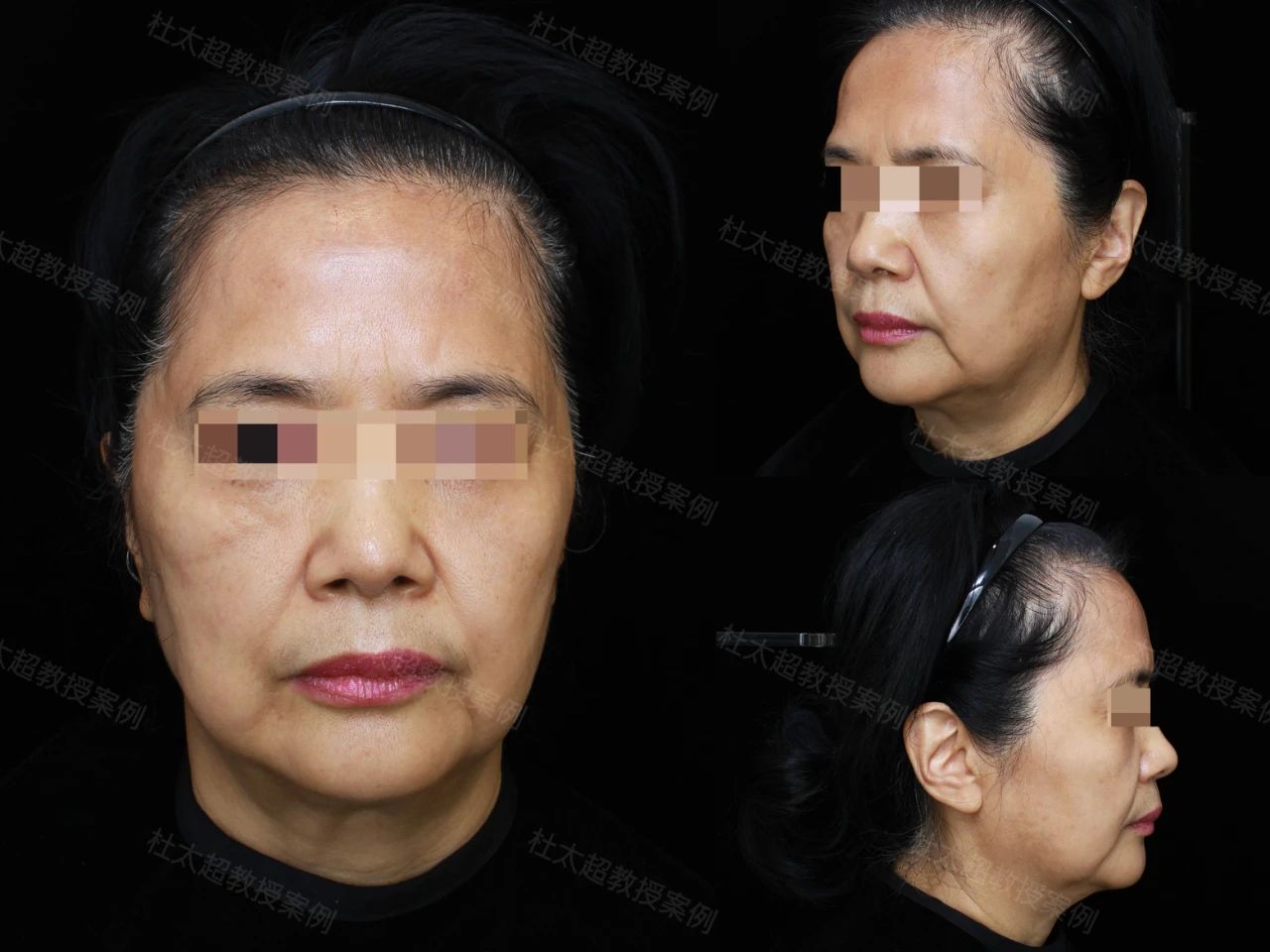 54岁求美者“大拉皮”手术术后20天深度分析