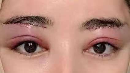 29岁求美者切眉术后恢复过程记录，真实分享