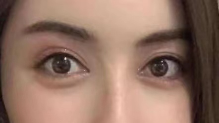 29岁求美者切眉术后恢复过程记录，真实分享